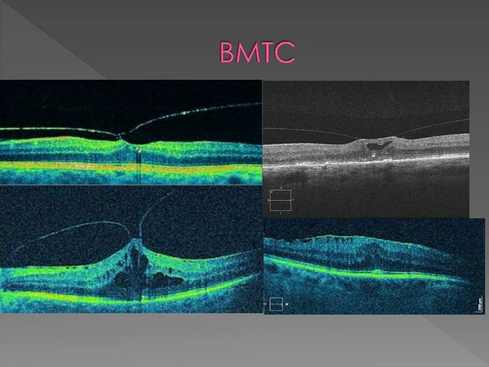 Эпиретинальный фиброз глаза. Эпиретинальный макулярный фиброз. Витторио макулярный тракционный синдром. Эпиретинальный фиброз окт. Эпиретинальная мембрана сетчатки.
