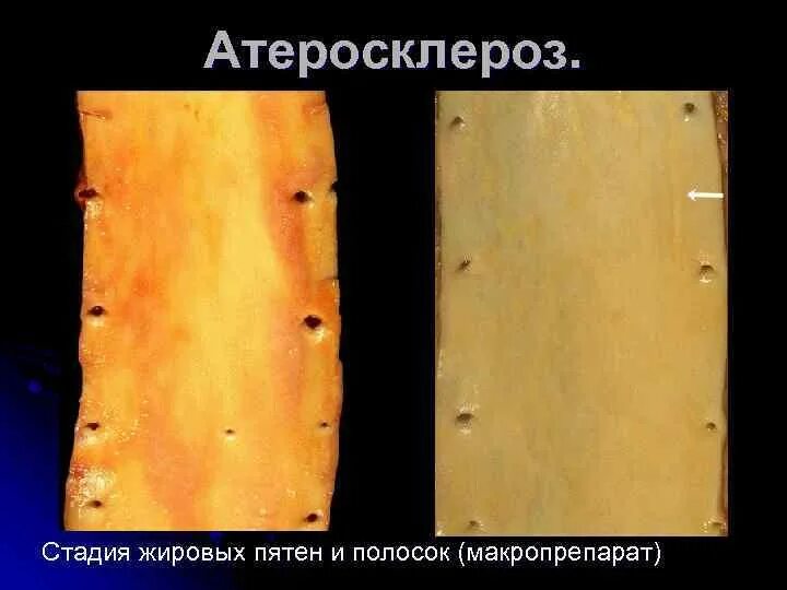 Атеросклероз аорты стадии. Атеросклероз аорты стадия бляшек макропрепарат. жировые пятна или полоски атеросклероз. липидные пятна и полоски. стадия жировых пятен и полосок.