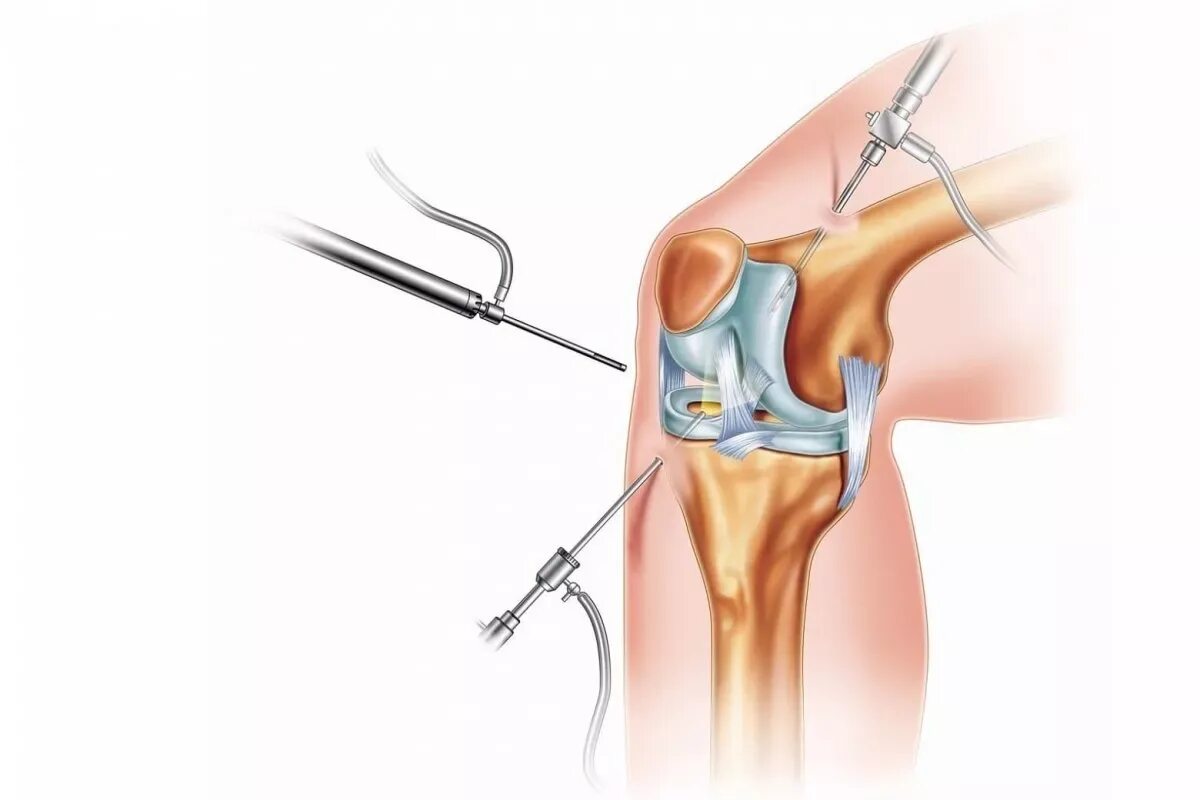 Как быстро восстановиться после удаления. Артроскопическая ревизия коленного сустава, резекция. Операция на мениске артроскопия. Операция артроскопия коленного сустава. Мениск коленного сустава операция.