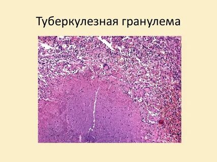 Гранулеза