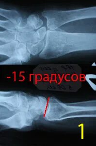 После перелома лучевой кости со смещением