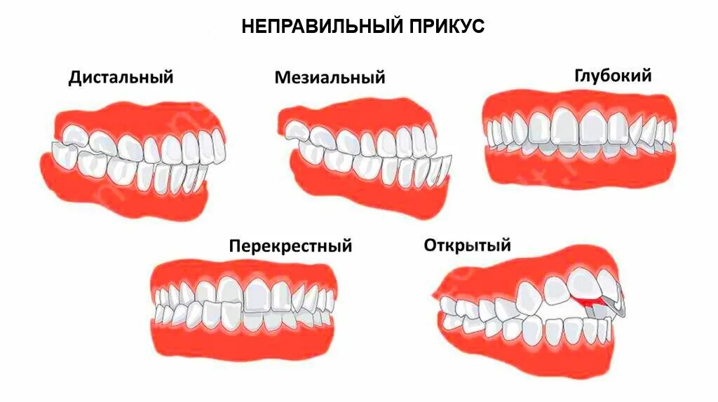 Почему зубы отличаются между собой. Дистальный прикус у ребенка 6 лет. Правильный прикус зубов. Неправильный прикус у ребенка дистальный.