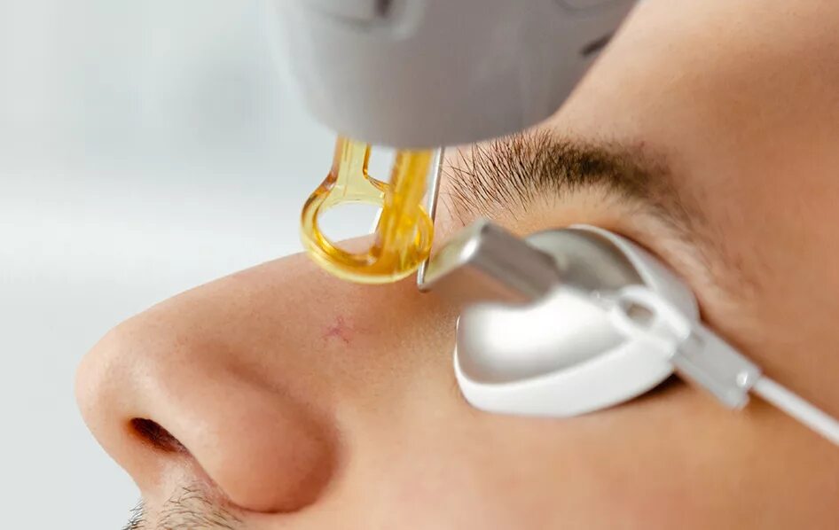 Омоложение сосудов. Лазерная коагуляция сосудов на лице. лазеротерапия сосудистых звездочек. лазерное удаление капилляров.