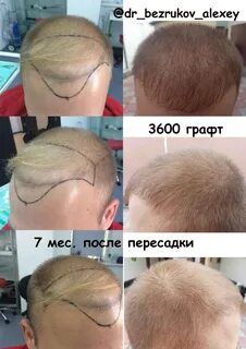 Сколько после пересадки волос