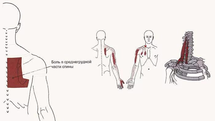 Лестничные мышцы триггерные точки. Триггерные точки боль мышцы спины. Широчайшая мышца спины триггерные точки.