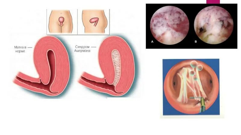 Синдром ашермана что это. Синдром ашермана картинки. Гистероскопия синехии. Внутриматочные синехии на узи что это такое. Внутриматочные синехии (синдром ашермана).