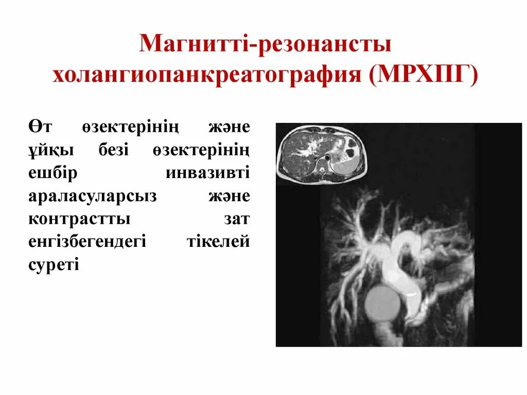 Холангиопанкреатография МРХПГ. Магнитно-резонансная холангиопанкреатография (MRCP, МРХПГ). МРХПГ поджелудочной железы. Холангиопанкреатография мрт.