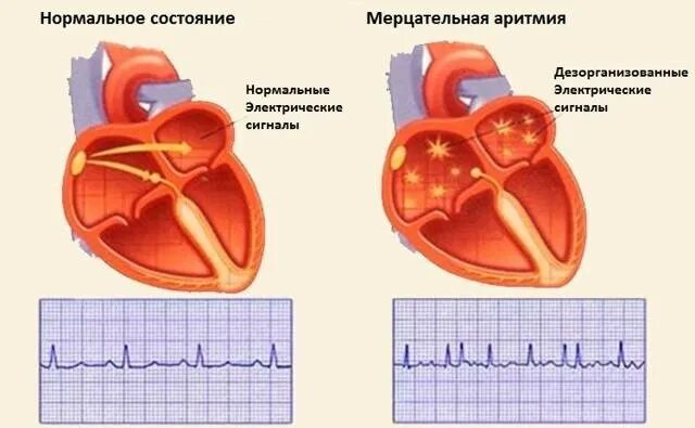 Мерцание предсердий. Фибрилляция сердца. Мерцательная аритмия симптомы. Клинический диагноз мерцательной аритмии.