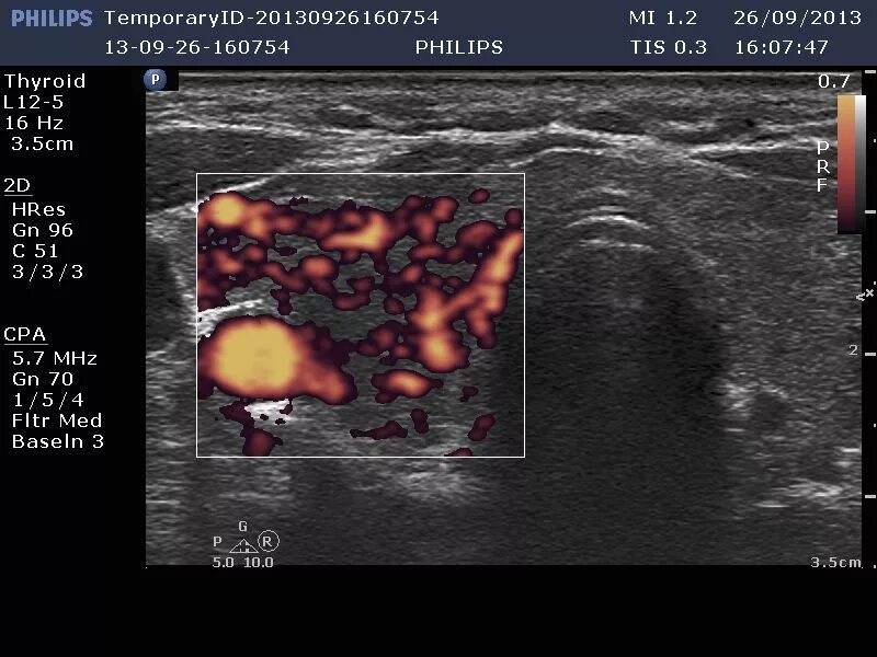 Усиленная васкуляризация. ЦДК кровоток щитовидной железы. УЗИ щитовидной железы УЗДГ. Васкуляризация паренхимы щитовидной железы. Паренхима щитовидной железы кровоток.