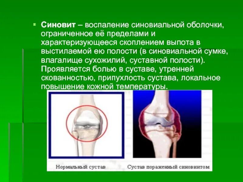 Синовит это. Синовит синовиальная оболочка. воспаление синовиальной оболочки.