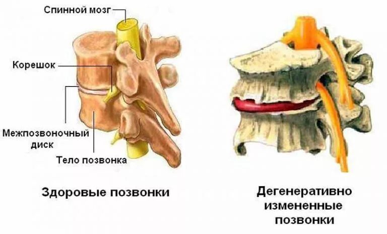 Дегенеративные поражения позвоночника. Дегенеративные заболевания диска межпозвоночного диска. Дегенеративные поражения грудного отдела позвоночника. Дегенеративных процессов в межпозвонковых диска. Дегенеративно-дистрофическое заболевание поясничного отдела.