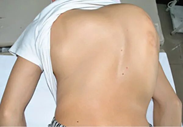 вертебральный компрессионный перелом. болит спина. лордоз шейного отдела отдела. кинезиотейпирование спины. ребенок ушиб спину.