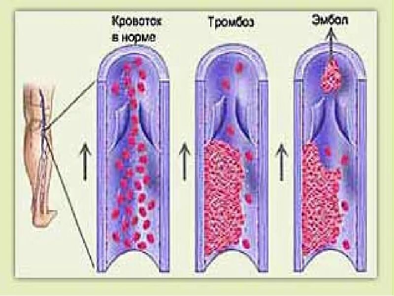 Части тромбов