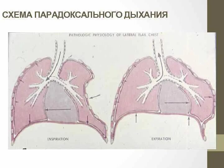 Парадоксальное изменение. Парадоксальное дыхание. парадоксальное дыхание выполнение. парадоксальное дыхание патогенез. парадоксальное дыхание это в медицине.