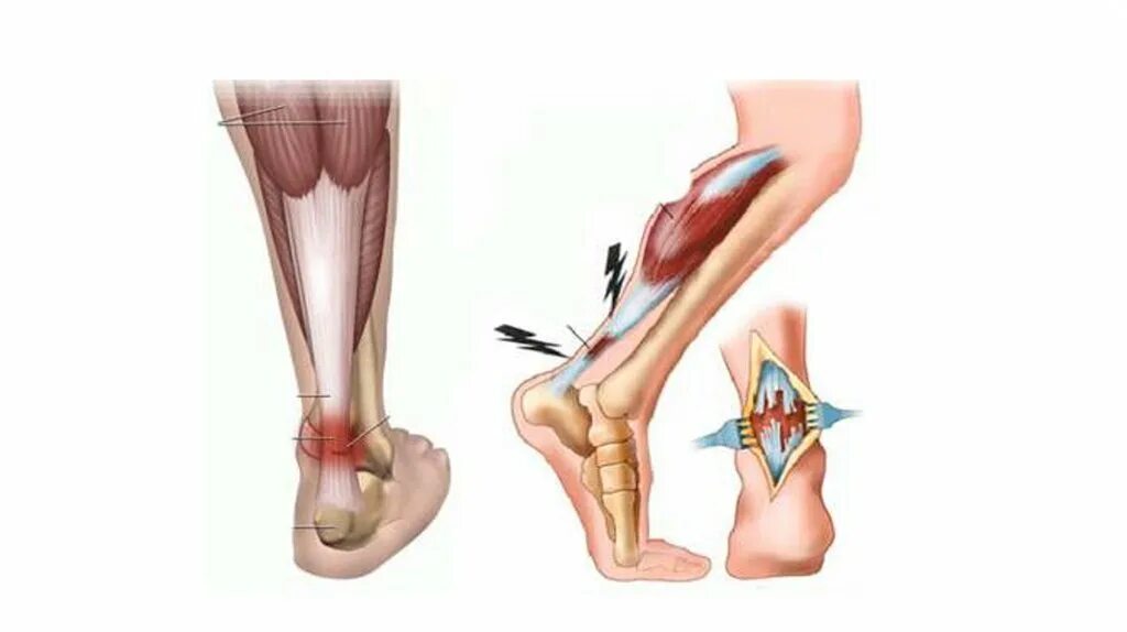 Связка ахиллова сухожилия. Ахиллово сухожилие растяжение. Бурсит ахиллова сухожилия в пятке. Тендопатия ахиллесова сухожилия. Трещина связке