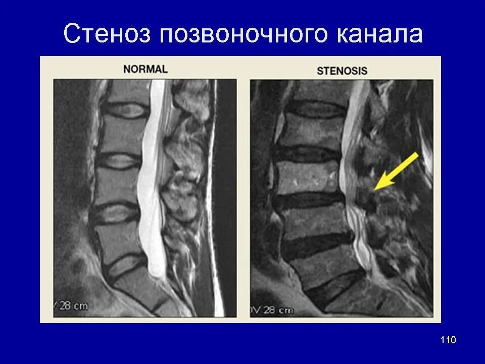 Можно вылечить стеноз. Стеноз позвоночного канала с1-с2. стеноз позвоночного канала l2-l3. дегенеративный спинальный стеноз l3-l4. абсолютный стеноз l4/s1.