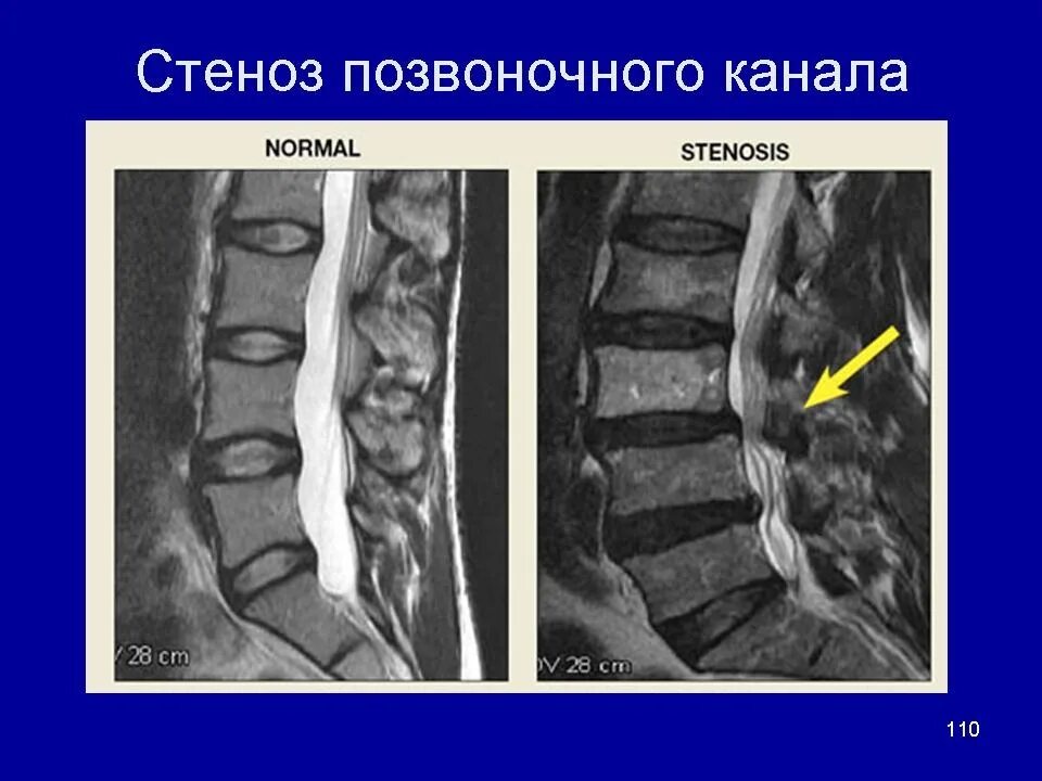 Крестцовый стеноз. Стеноз позвоночного канала с1-с2. Стеноз позвоночного канала l2-l3. Дегенеративный спинальный стеноз l3-l4. Абсолютный стеноз l4/s1.