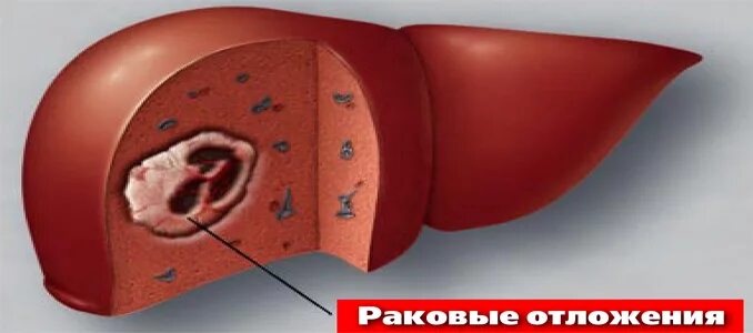 Печень в 4 года. Гемангиосаркома печени гистология. Гемангиосаркома селезенки гистология. Гепатобластома печени у детей.