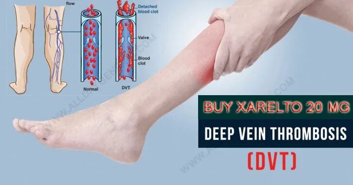 Схема Ксарелто при тромбозе. Ксарелто при тромбозе. Ксарелто при тромбозе вен