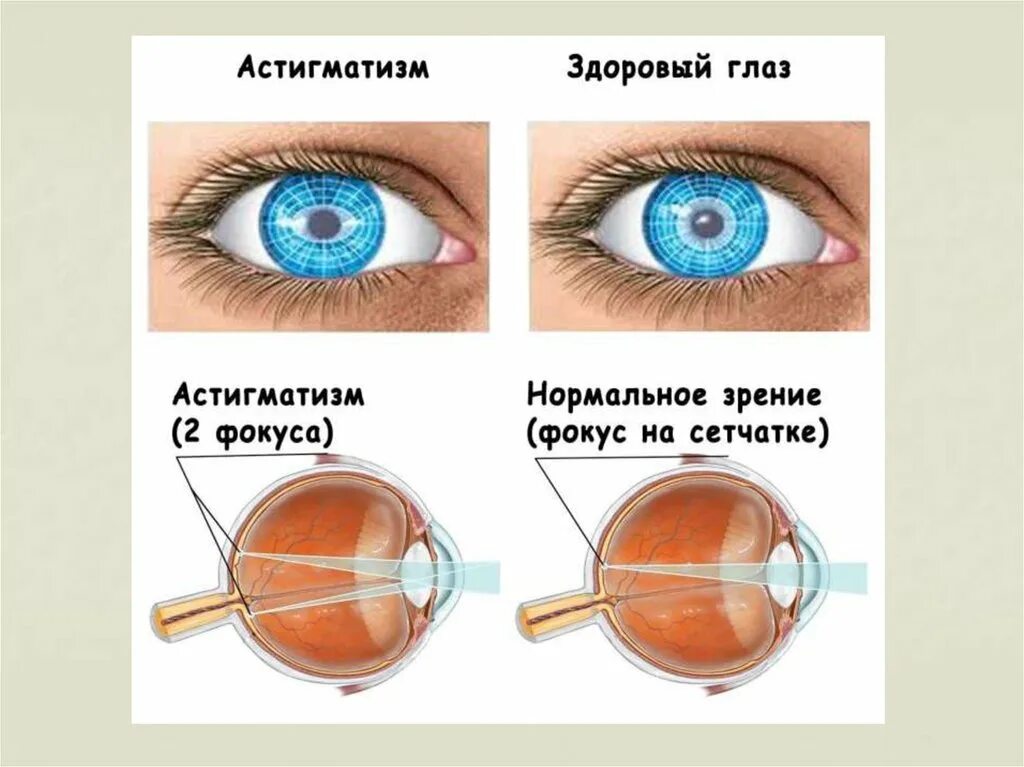 Почему не видит один глаз. Почему не видит один глаз