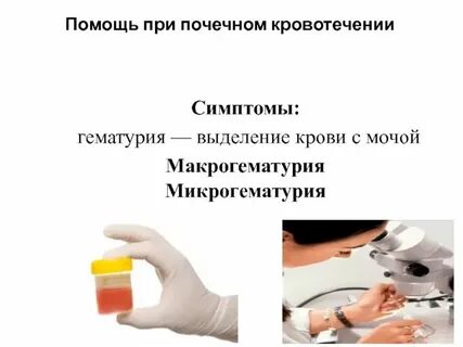 Никтурия гематурия