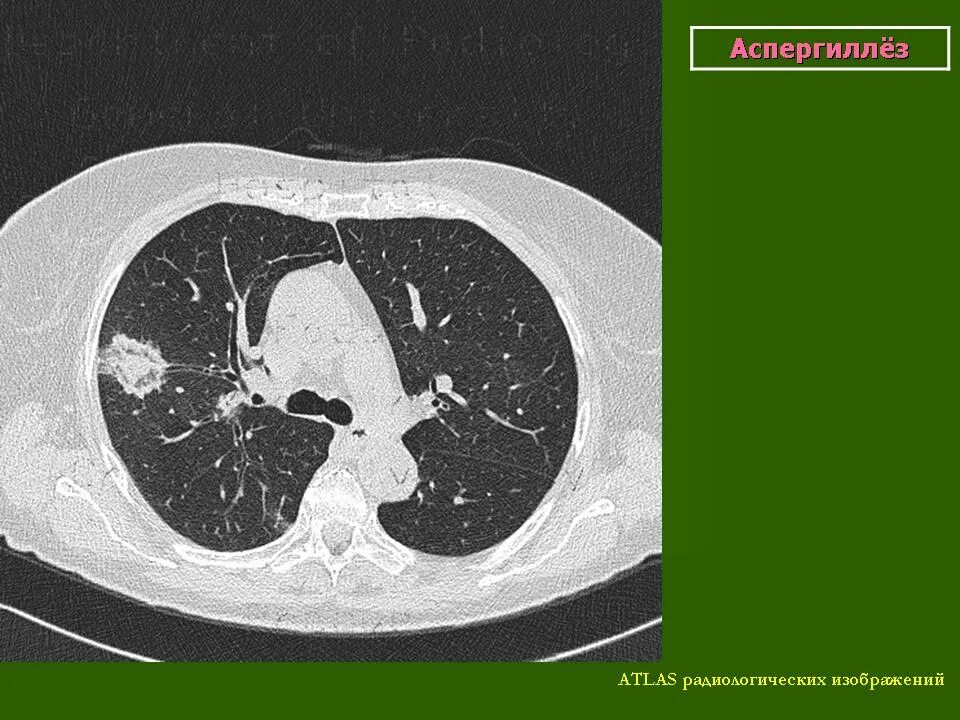 Кт картина. Аспергиллез легкого кт. Аспергиллез пневмония кт. Инвазивный аспергиллез кт. Аспергиллез кт картина.