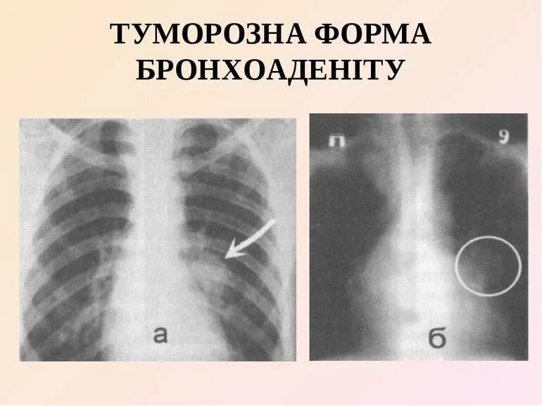 Бронхоаденит это. Туморозная форма туберкулеза внутригрудных лимфатических узлов. туморозный бронхоаденит. туморозный бронхоаденит рентген.