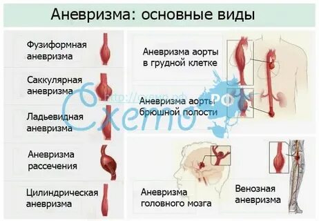 Аневризма что это такое простыми словами
