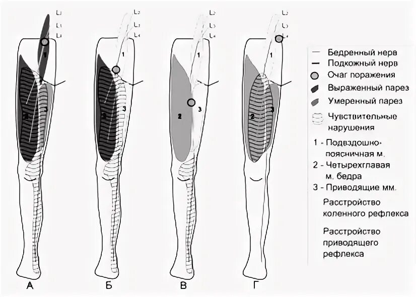 Невропатия бедренного нерва. Нейропатия подкожного нерва бедра. Латеральный подкожный нерв бедра. Подкожный нерв бедренного нерва.