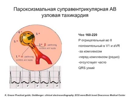 Узловая тахикардия