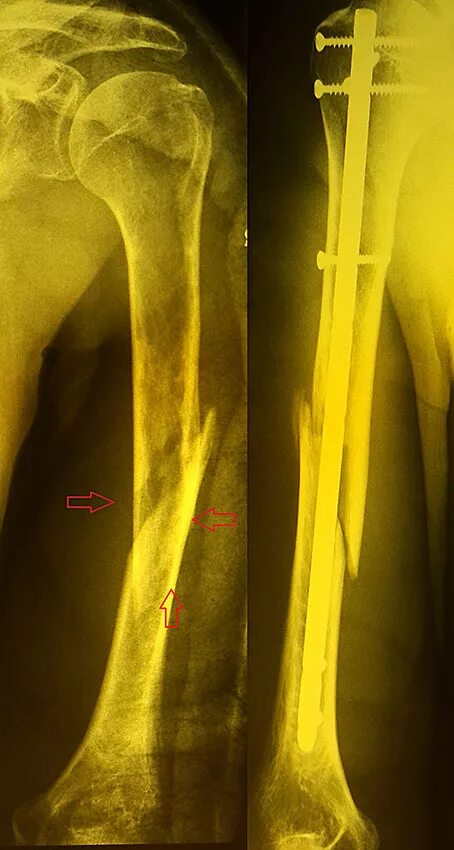 Остеосинтез перелома плечевой кости. Остеосинтез диафиза плечевой кости. Перелом плеча остеосинтез. Остеосинтез хирургической шейки плеча пластиной. Перелом плеча пластина