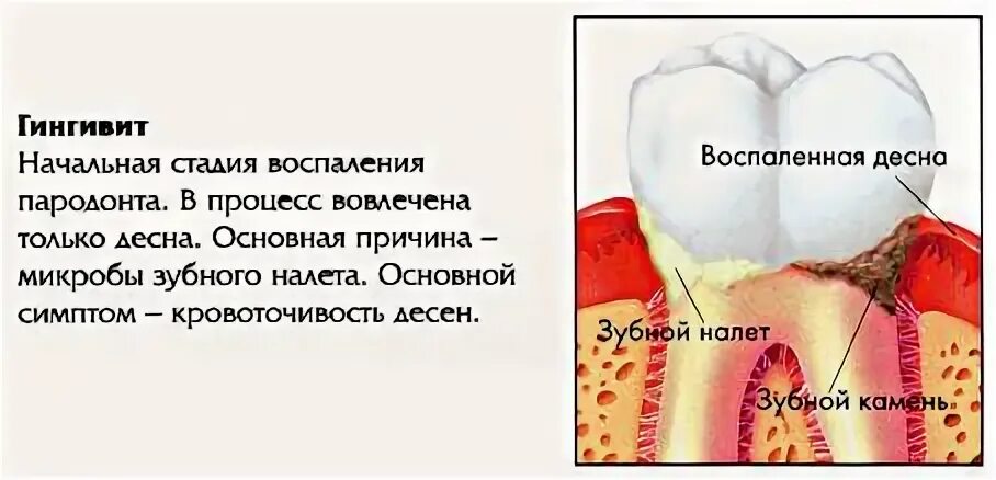 Как отличить зубную боль от воспаления