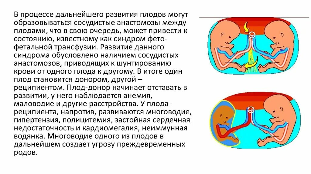 Синдром донора. Фето-фетальный трансфузионный синдром УЗИ. Синдром плацентарной трансфузии. Фетафитальный синдром.