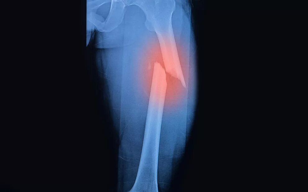 Перелом бедренной кости рентген. Перелом диафиза бедренной кости рентген. Диафизарные переломы бедренной кости.
