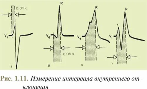 Расщепление зубца. Расщепление зубца r на экг в 3 отведении. расщепленный зубец r в 1 отведении. расщепление зубца r в v3. раздвоенный зубец r на экг.