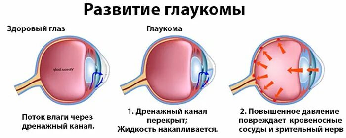 Глазное давление у детей. Этапы развития глаукомы. Глаукома схема глаза. Схема операции при глаукоме. Внутриглазное давление при стадиях глаукомы.