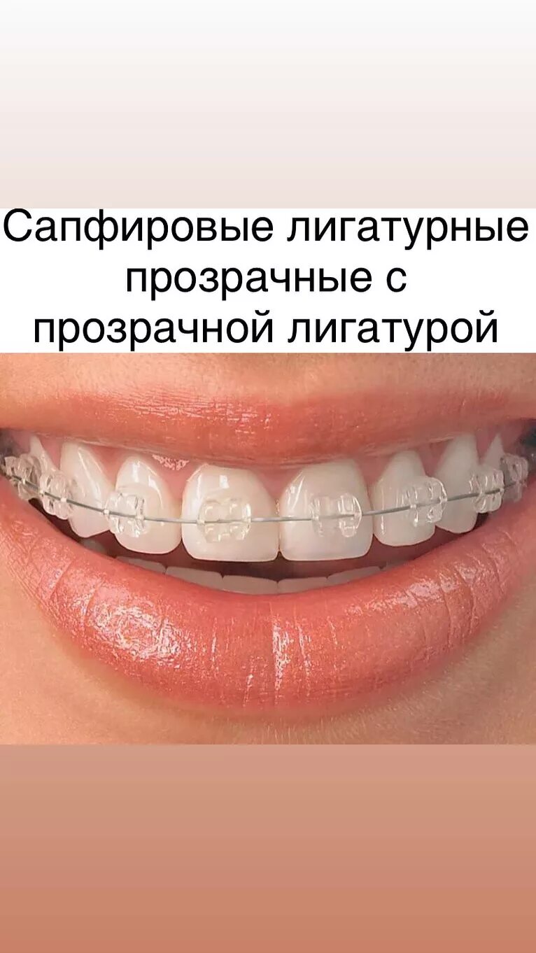 пластиковые брекеты. сколько стоят брекеты в вологде. красивые брекеты. сколько стоят брекеты в вологде. сапфировые брекеты с белой дугой.
