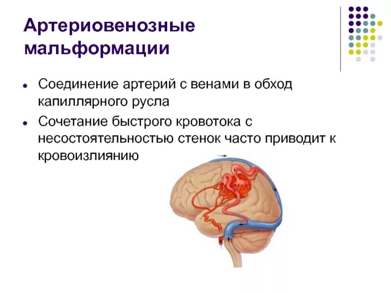 Что такое мальформация головного мозга. Артериовенозная мальформация (авм). ангиоматозная мальформация. артериовенозная мальформация патанатомия. артериовенозная мальформация головного мозга.