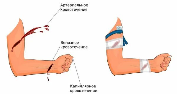Как выглядит венозное кровотечение на руке কেটে গেলে ঘরোয়া উপায়ে রক্তপাত বন্ধ করবেন যেভাবেHow to stop the bleeding in the d