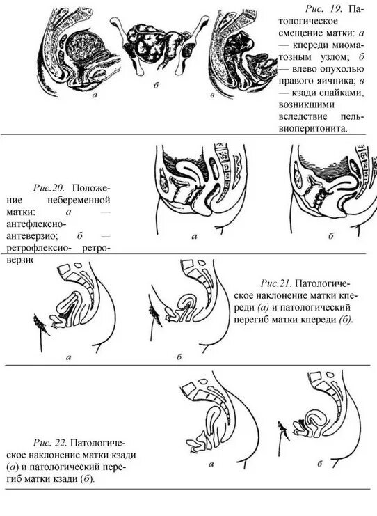 Выпадение женских половых. Расположение шейки матки кзади. Матка антефлексио при беременности. Загиб шейки матки кпереди. Загиб матки кзади положение.