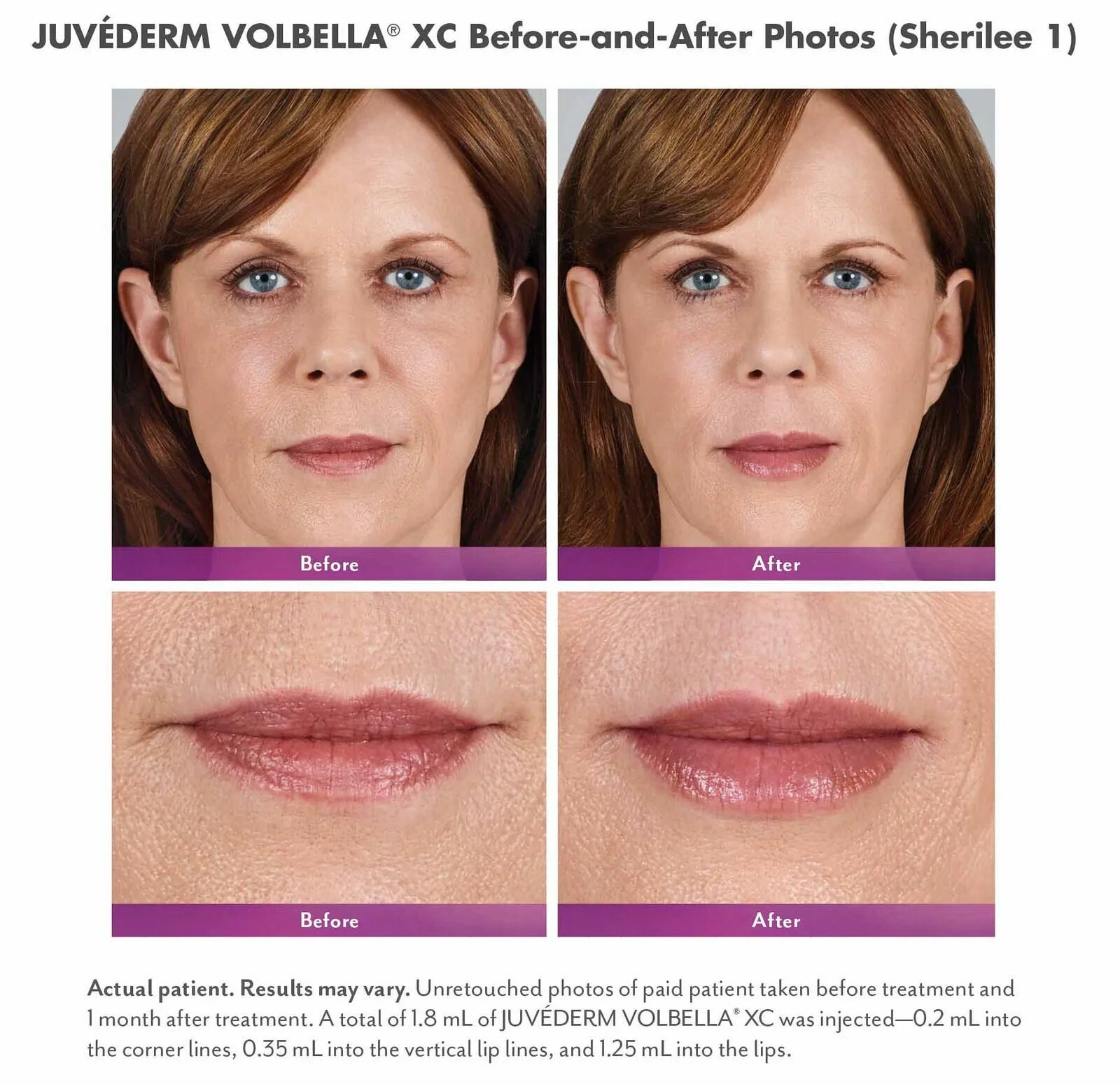 Губы после ювидерм. Voluma Juvederm губы. Филлеры Ювидерм 1. Ювидерм Volbella. Филлер Volbella.