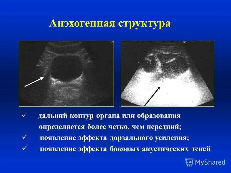 Образование вытянутой формы. Анэхогенное образование. образование анмогенное. анэхогенная структура яичника. акустическое усиление на узи.