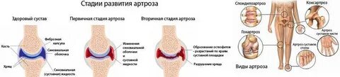 Артрит и артроз коленного сустава лечение