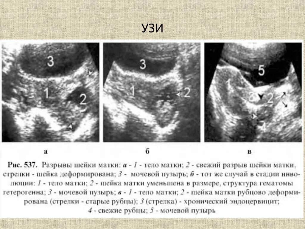 Эхограмма гиперплазии эндометрия. Бугорок на матке при пальпации. Бугорок на матке при пальпации. Поверхностная пальпация кишечника. Бугорок на матке при пальпации.