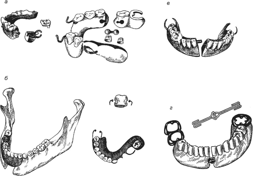 Подвижное соединение челюстей. Несъемный протез с шарниром и.м.Оксмана.. Съемный Шарнирный протез по Гаврилову е.и.. Классификация ложных суставов нижней челюсти (по и.м.Оксману).. Съемный Шарнирный протез по Вайнштейну б.р.