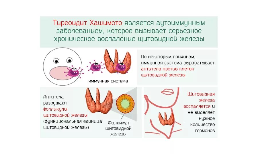 Хронический аутоиммунный тиреоидит патогенез. Щитовидная железа болезнь Хашимото. Аутоиммунный тиреоидит Хашимото этиология. Тиреоидит Хашимото патофизиология.