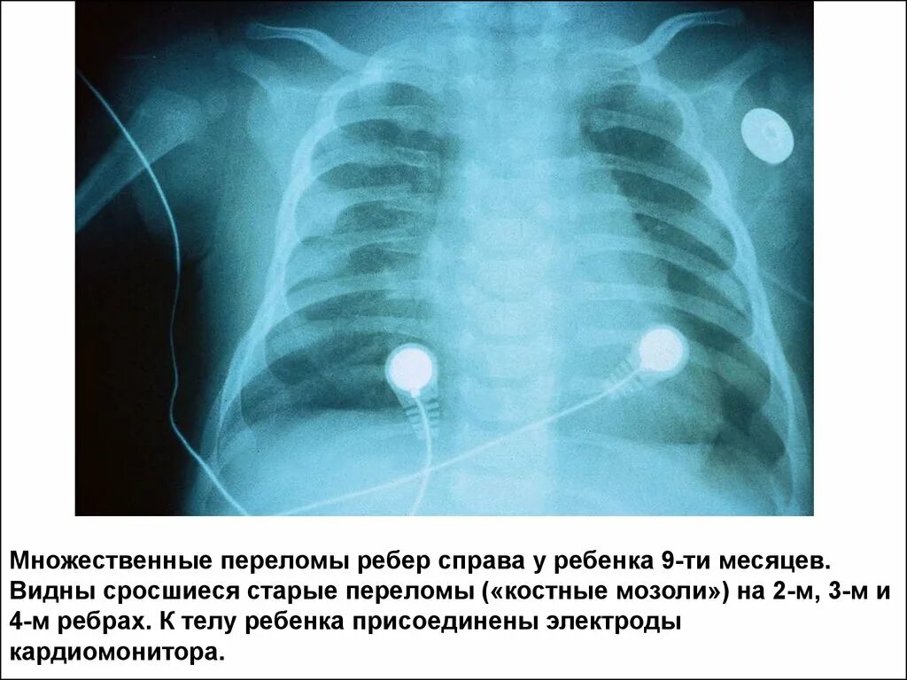Множественные переломы ребер рентген. Костная мозоль ребра на рентгене. Множественные переломы ребер. Сросшийся перелом ребра рентген.