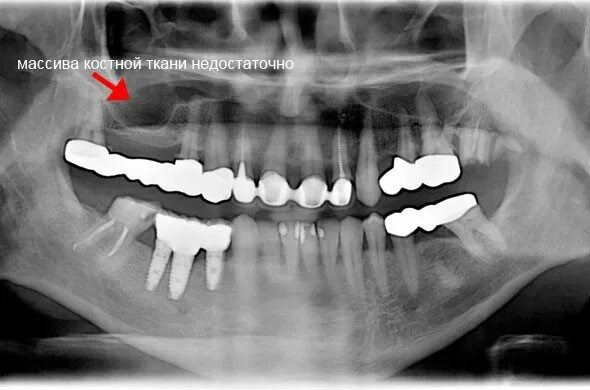 Аугментация костной ткани. Биохимия костной ткани. Компактная пластинчатая костная ткань. Мало костной ткани. Наращивание костной ткани при имплантации зубов.