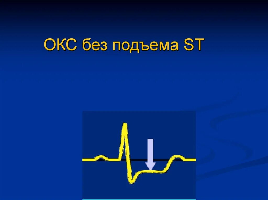 Острым коронарным синдромом без. Острый коронарный синдром без подъема сегмента St. Окс с подъёмом St и без подъема сегмента St ЭКГ. Окс без подъема St на ЭКГ. Окс c подъемом сегмента St.