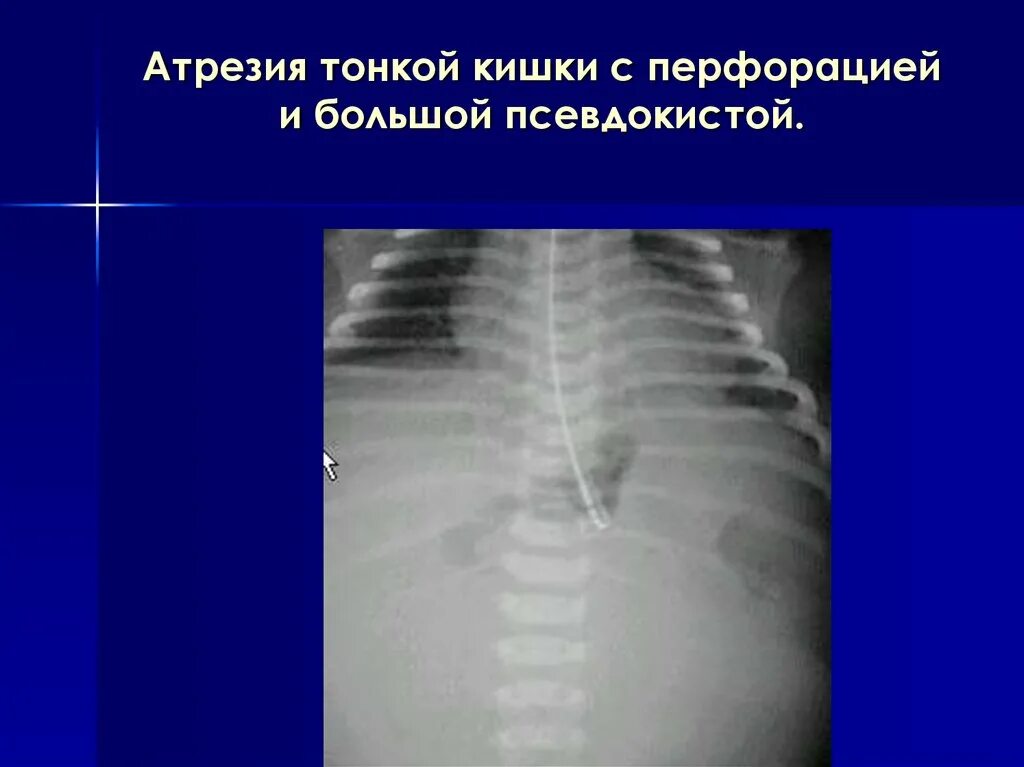 Что такое перфорация кишечника. Атрезия 12 перстной кишки рентген. атрезии кишечника патанатомия. атрезию тонкой кишки рентгенограмма.
